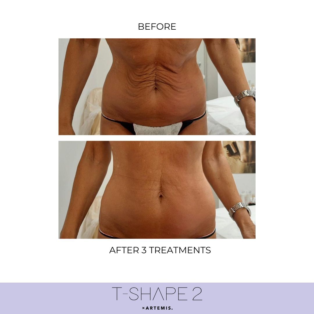 T-Shape 2 abdomen contouring results after 3 treatments at iCRYO Guilderland