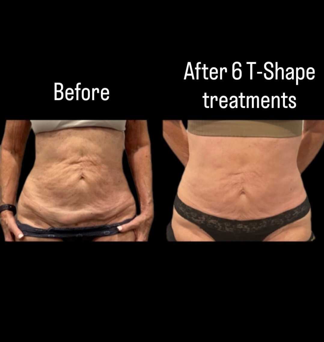 T-Shape 2 abdomen skin tightening before and after 6 treatments at iCRYO Guilderland