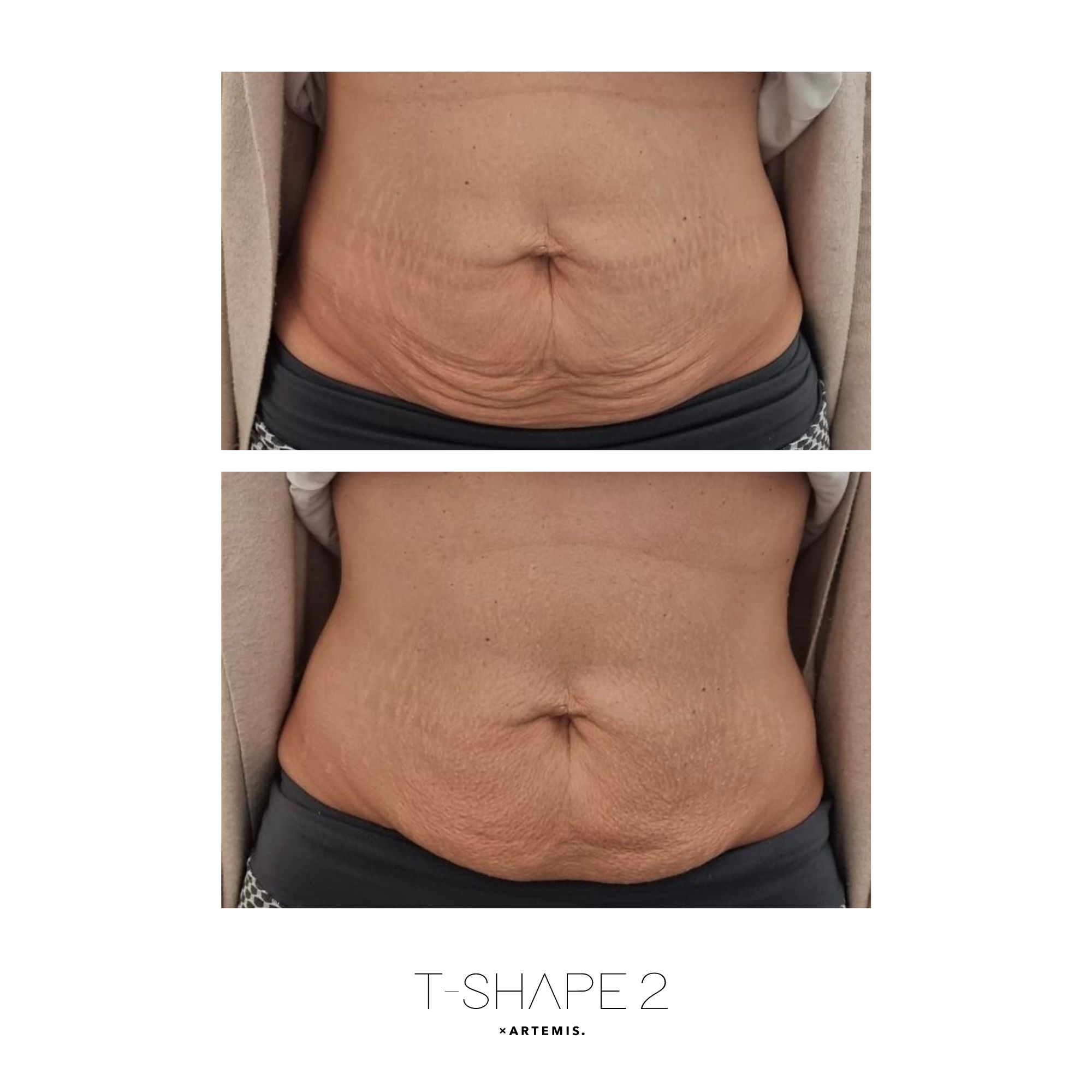 T-Shape 2 abs results after treatment series at iCRYO Guilderland