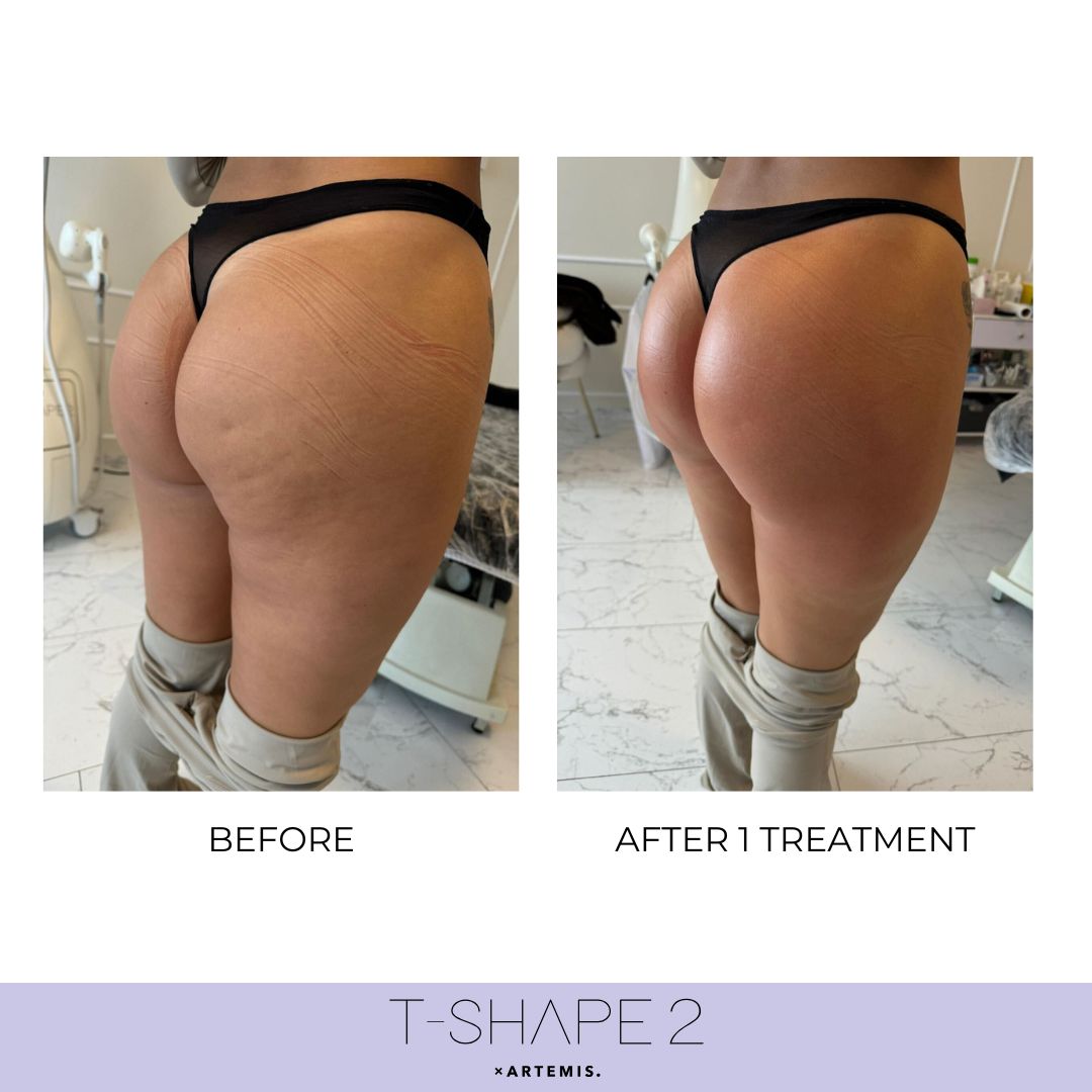 T-Shape 2 body sculpting results after 1 treatment at iCRYO Guilderland