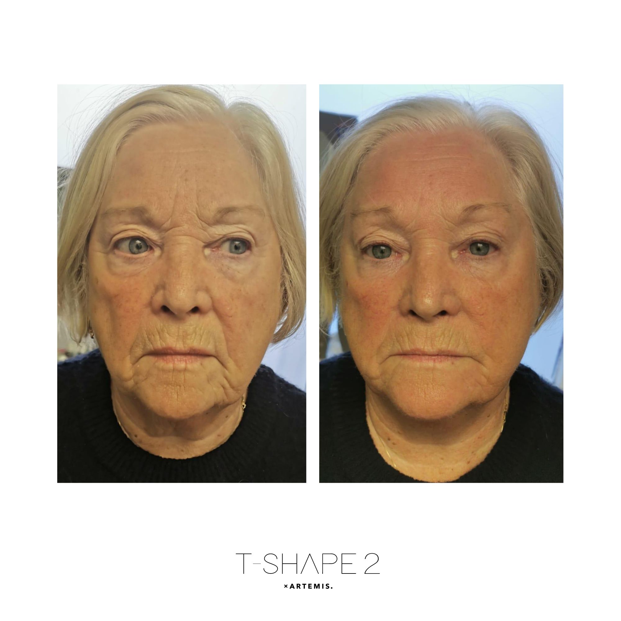 T-Shape 2 face tightening results after 1 treatment at iCRYO Guilderland