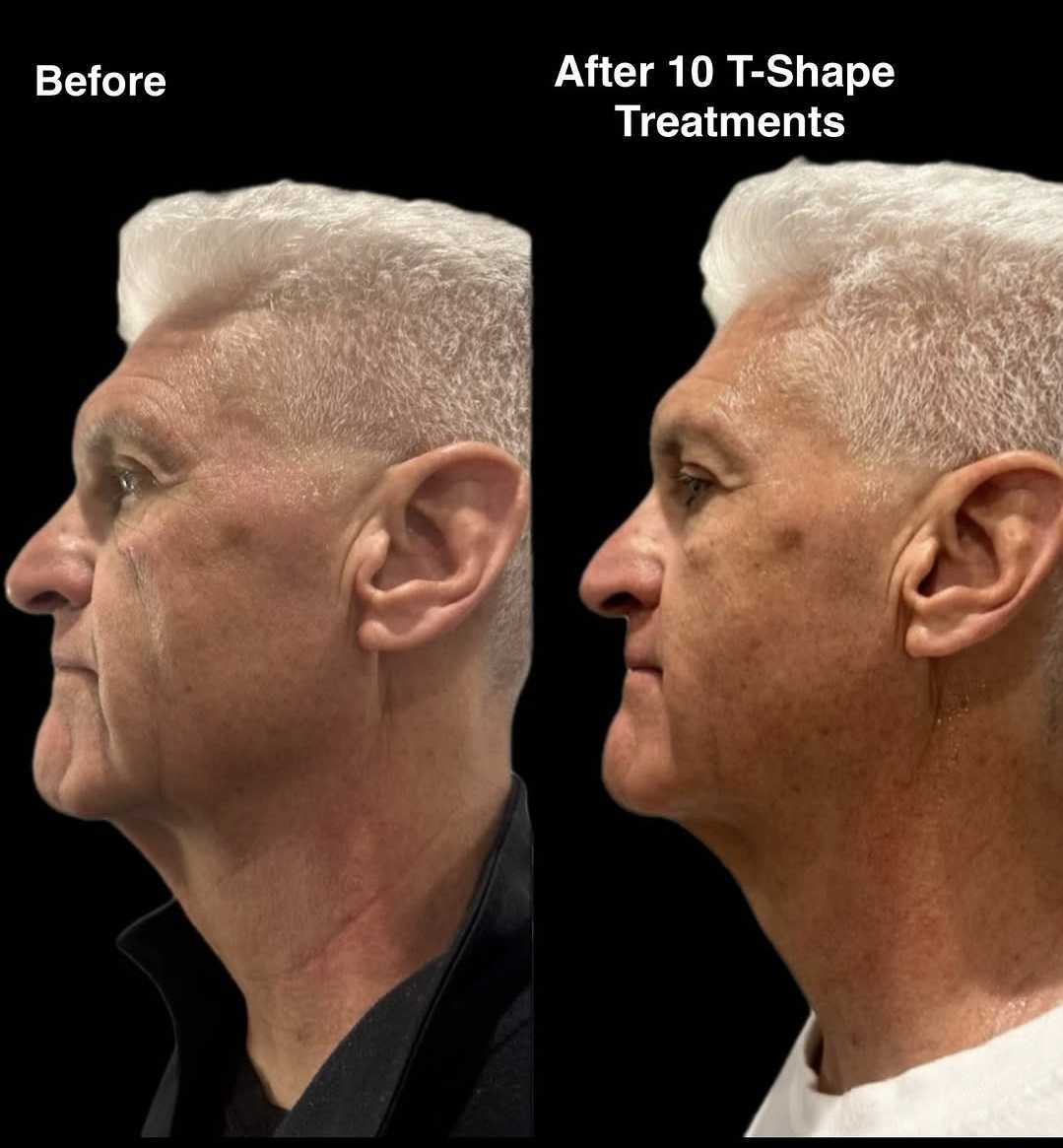 T-Shape 2 face and jawline tightening before and after 10 treatments at iCRYO Guilderland