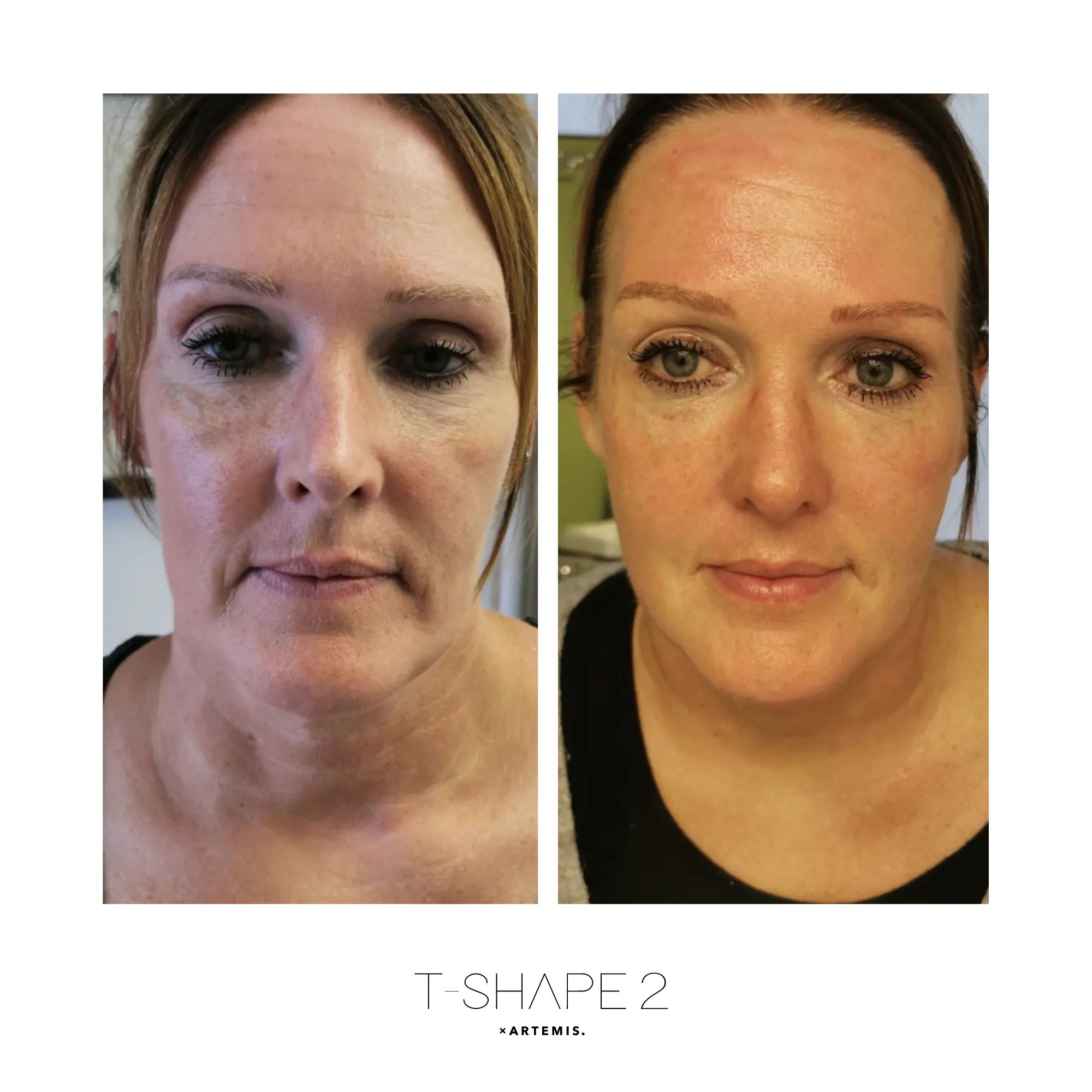 T-Shape 2 facial rejuvenation results after 4 treatments at iCRYO Guilderland