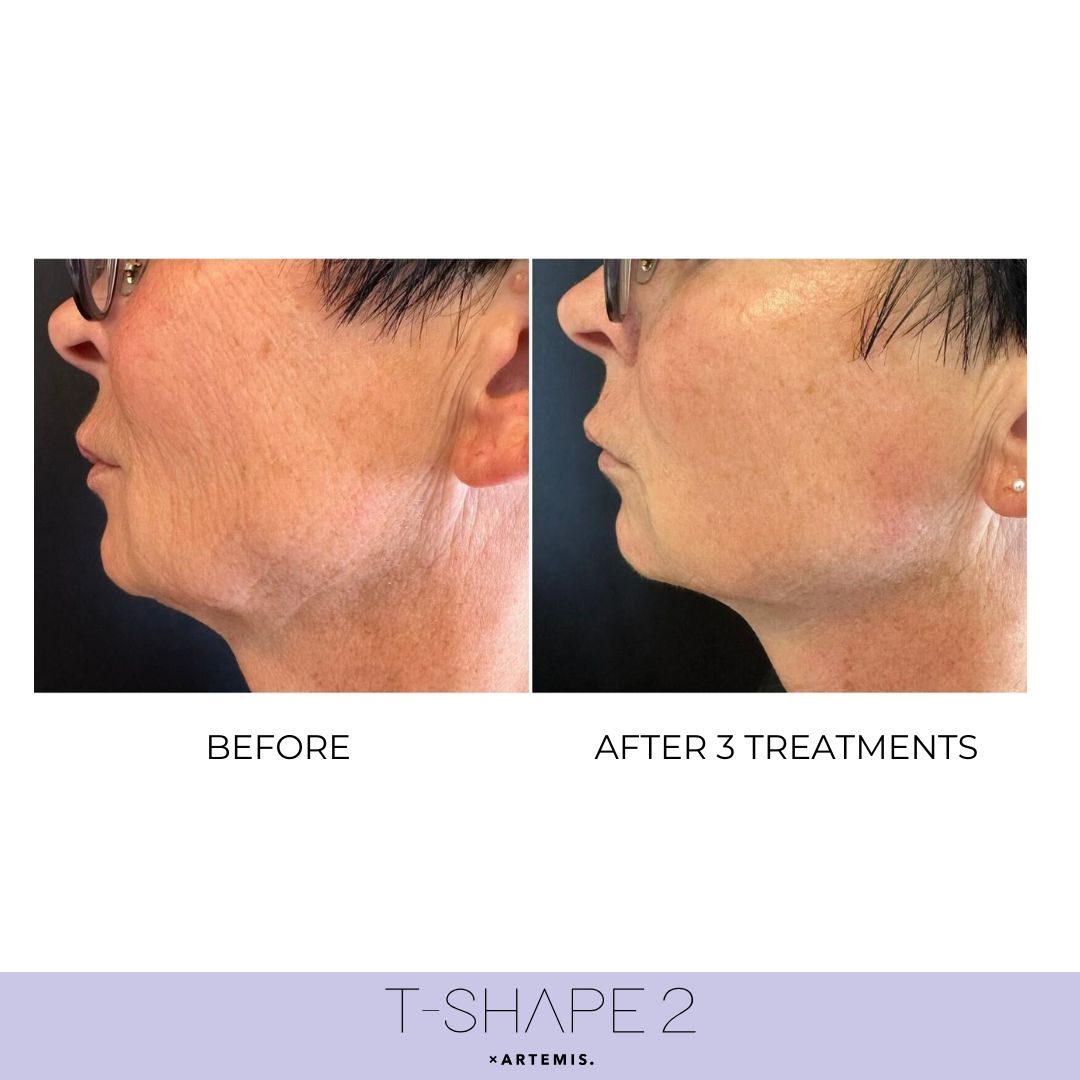 T-Shape 2 neck firming results after 3 treatments at iCRYO Guilderland